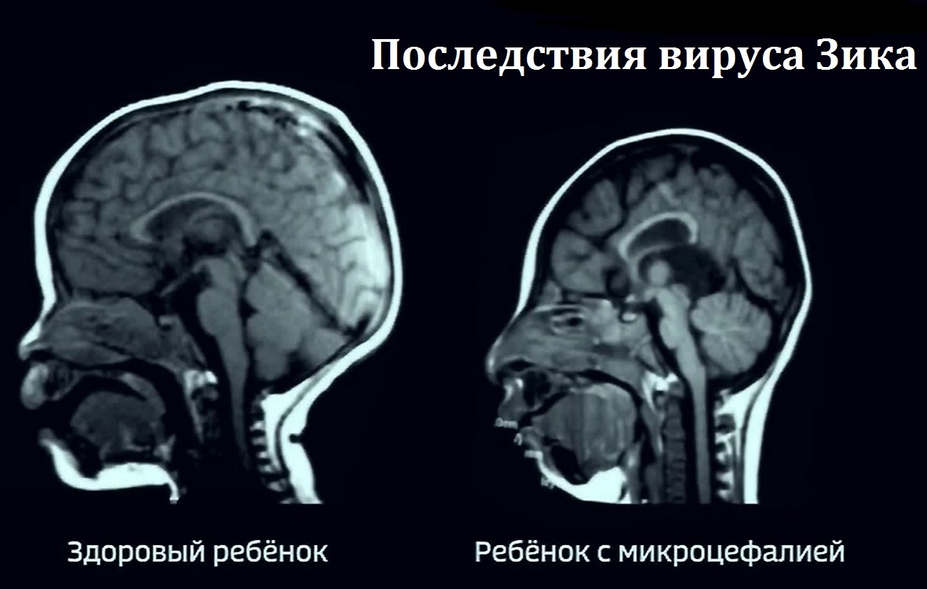 Вирус Зика